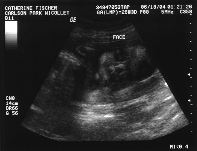 Face Ultrasound
This picture shows William's face.  It is from Cathy's second ultrasound on June 18, 2004.   Cathy was 26 weeks pregnant when these pictures were taken.  
