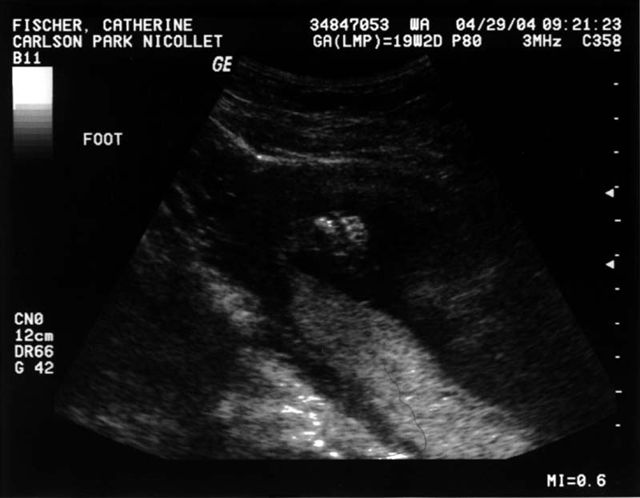 Foot Ultrasound
This picture shows William's foot.  It is from Cathy's first full ultrasound taken on April 29, 2004.   Cathy was 19 weeks, 2 days pregnant when it was taken.
