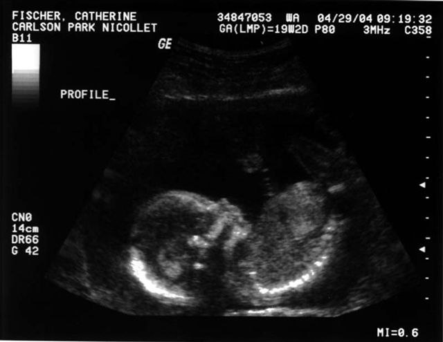 Profile Ultrasound
This picture shows William's profile.  It is from Cathy's first full ultrasound taken on April 29, 2004.   Cathy was 19 weeks, 2 days pregnant when it was taken.
