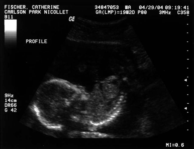 Profile Ultrasound
This picture shows William's profile.  It is from Cathy's first full ultrasound taken on April 29, 2004.   Cathy was 19 weeks, 2 days pregnant when it was taken.
