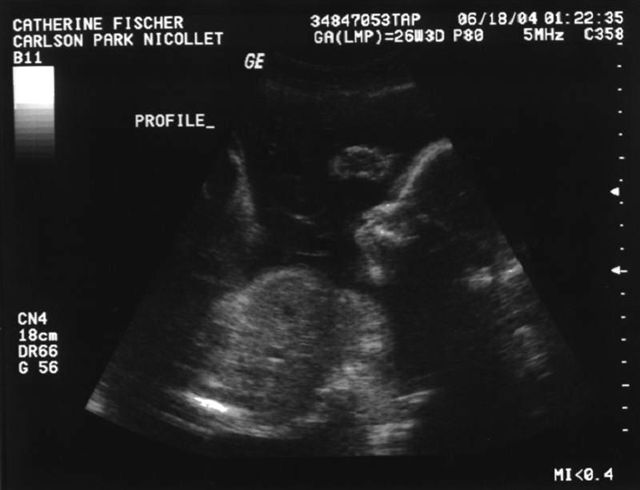 Ultrasound Profile
This picture shows William's face.  It is from Cathy's second ultrasound on June 18, 2004.   Cathy was 26 weeks pregnant when these pictures were taken.  
